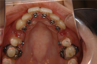 舌側矯正装置が歯の内側に装着されています。